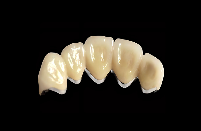 Base Metal PFM